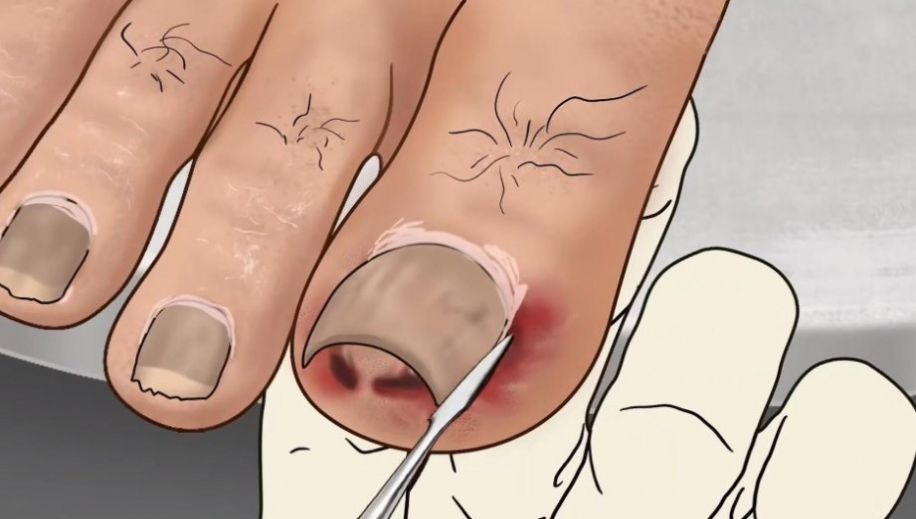 修脚足疔模拟器游戏图1